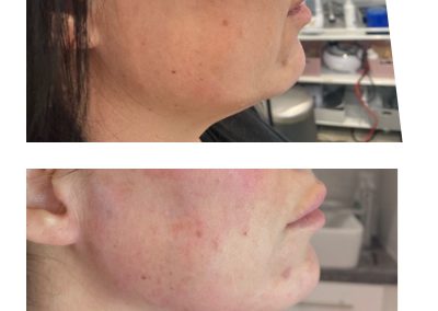 Before & After Treatment - Clinic Young