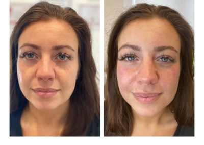 Before & After Treatment - Clinic Young